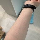 김태진 | [서울아산병원 알레르기과 김태진 교수] 두드러기 치료일기 + 졸레어주사 후기