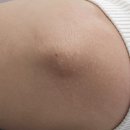 수원-1483 | 미백케어 수원 아논뷰티 팔꿈치 멜라닌케어 후기!! ft. 겨드랑이미백 고민 관리