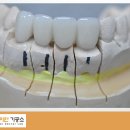 이천치과기공소 네이버블로그