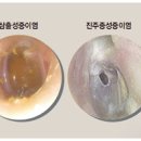 중이염 어떠한 이 나타나는지 궁금하다면 이미지