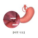 바렛식도(Barrett's esophagus) 이미지