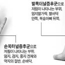 잦은 손발 저림, 혈액순환 문제 아닌 신경 압박 때문 이미지