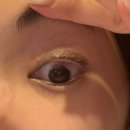 밝은e안경 | [렌즈삽입술 경과] 렌즈삽입술 1~6일차 후기/렌삽 관리법,꿀팁 정리
