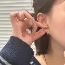 이혈 테라피 | wbl 주얼패치 스왈 이혈테라피 귀침 만족 후기