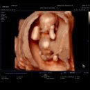 한주1차 | 임신 10주~12주 기록 | 1차 기형아검사 후기, 목투명대 정상 수치, 12주 성별 힌트?!