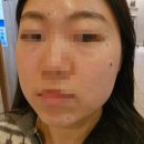 리뉴미피부과의원 | 리뉴미피부과 내돈내산 점 제거 후기 및 주의사항