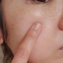 엔도테크놀러지 | 니들리 엔도스킨 보톡플러스 풀키트 솔직후기