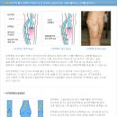 옆지기가 하지 정맥류수술을 받았답니다. 이미지