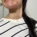 10년째 여드름. 진균성일까? 세균성일까? 라미실, 에스로반 후기