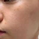 에프앤코명동주 | 명동피부과 광채주사 엘라비에 밸런스 물광 후기!!