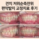 HIGH-CLASS | 견치 저위순측전위 교정치료 후기 [High canine]