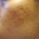 대화한의원 | 여드름파인흉터 효과 봤었던 한의원 후기