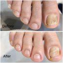 레푸스선릉점 인디고네일 | 서울 내성발톱 교정 레푸스 선릉점 케어 후 예뻐진 발로 변신!