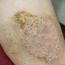 연제한의원 | 부산피부한의원에서 진짜 치료될 수 있을까? 3가지만 확인하세요