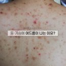 강남동일한의원 | 등필링 강남 한의원의 실제 전후 사진 공개(후기 및 가격 알아보신다면?)