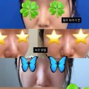 빨간코실비 | ⁠[내돈내산] 발품 없이 바로 예약한 <코막힘 비중격만곡증+비염 수술+미용코> 기능코 성형 후기 (1탄)