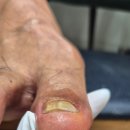 대구 범어동 발톱무좀 두꺼워진 발톱 관리받은 네일바이엘 후기