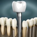 남부치과의원 | 서울 관악구 임플란트 치과 잘하는 곳, 가격 비용 싼 곳 BEST10 추천