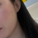 바른침한의원 | 신논현 피부과 한의원 | 패인 흉터 제거 | 새살침 치료 | 3회차 후기