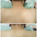 천안 RPC | 천안등드름 / 천안바디여드름케어 / 천안RPC / 목덜미여드름 / 불당여드름흉터 / 정품로즈필링 / 실패...