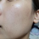 대일전문정비 | 얼굴 요철 눈가비립종인줄 알았으나 알고보니 편평사마귀?! 천호 [화이트피부과]에서 레이저로 제거완료...
