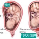 전치 앞(1) 이미지
