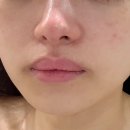 아름 | 진해 피부관리 아름에스테틱 플라즈마 관리 후기