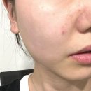 멍이랑 양이랑 | 동대문피부과에서 리쥬란힐러 내돈내산 솔직후기 (feat. 리쥬란 덜 아프게 맞는 팁)