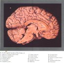 brain stem(뇌간:腦幹) 이미지