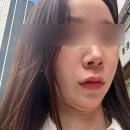 백앤미의원 | [뷰티] 온다리프팅 6만줄 후기 뷰티영앤의원 신사점, 슈링크 티타늄 차이까지