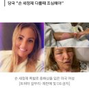 손 세정제 바른 채 촛불 켜다 '펑'…미 여성 전신 중화상 이미지