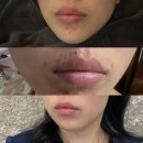 리페로 | 일산 백석 여드름관리 솔에스테틱 일산점 리페어필 입가여드름 솔직 후기