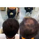 뷰티살롱채움 | 남자 정수리 탈모, 2000모 숱 채움으로 달라진 리얼 후기 (약 복용 중 고객 사례)