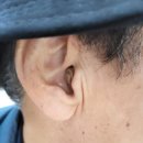 스타키보청기 | 김제보청기, 스타키 제네시스 CIC 보청기 사용후기 (70대 남성)
