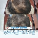 무크헤어 - 순천시 공마당길 54-1 | 가산SMP 두피커버 잘하는 곳 무크스칼프디자인 헤어라인 커버 1차 후기