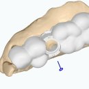 애플치과기공소 이미지