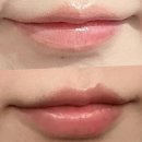 멍타임 | 자연스러운 입술필러 리터치까지 마곡피부과 후기 내돈내산 | 다운타임, 멍, 보습제 립밤