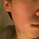 오투헤어(02헤어) | 강남 논현 피부과 리즈네 통증 스킨부스터 엠보 주사자국 없어지는 과정 5일차까지