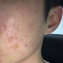 리얼유의원 | 피부관리:) 8일차, 트리플 색소레이저 후기 !!