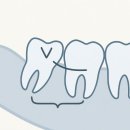 천안대학약국 | 매복 사랑니발치 후기 | 천안 신부동 턱앤사랑니치과