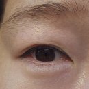 비에이의원 | 아이리쥬란 내돈내산 후기 리쥬란 통증 대전 스킨부스터