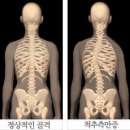 [척추측만증증상] 척추측만증 척추관절클리닉에서 알려드리는 척추측만증증상에 관한 정보 -강북 척추질환전문 연세사랑병원- 이미지