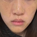 제로뷰티 | 수원 용인 기미잡티 제거 미작뷰티 수원점 제로스팟 후기