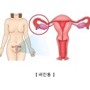 배란통[Ovulation pain]여성질환 이미지