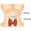 의학과한방(동영상):갑상선 기능 저하증 (Hypothyroidism) 이미지