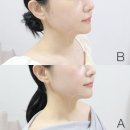 바비든든 | 강남언니 VS 바비톡 세르프 후기 찾아본 성형시술 어플 "바비톡" 추천