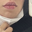 죽쑤어개준다 | 고통의 11월과 12월 사이 (입술 필러, 문신, 브라질리언 왁싱)