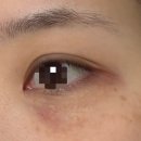 아그네스 | 인천 구월동 한관종 아그네스 후기｜4일차 변화 통증 솔직후기