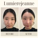 7577 | 송도 피부관리 루미에르잔에스테틱 페이스라인&amp;이중턱 관리 후기