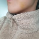 산본엘치과의원 | 매복사랑니 발치 후기+꿀팁ㅠ